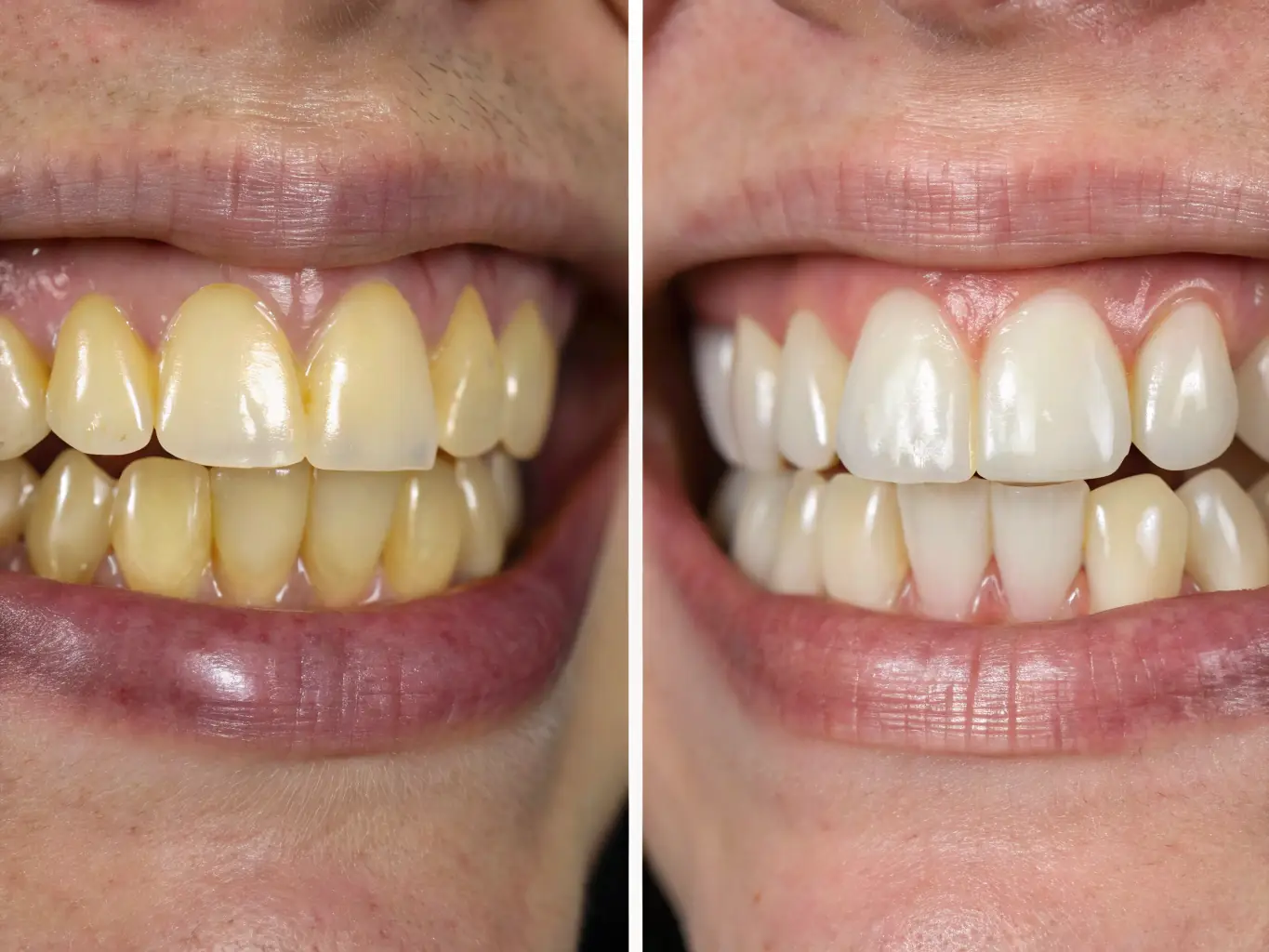 A before-and-after image showcasing the transformative effect of veneers on a patient's smile. The 'before' image should show teeth with imperfections, while the 'after' image displays a bright, even smile.